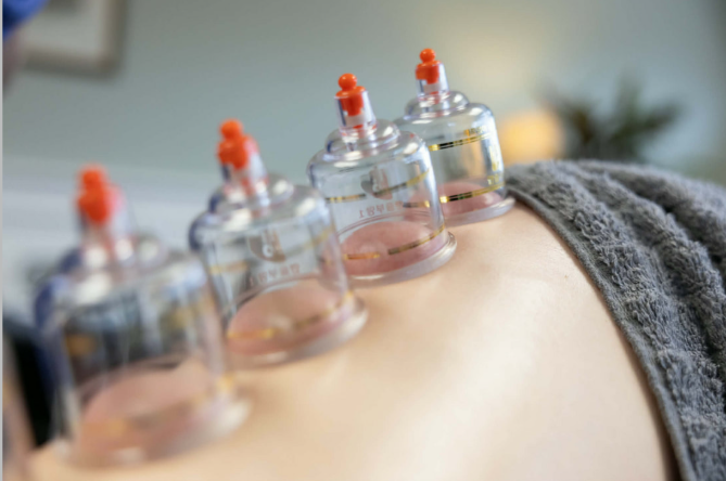 cupping-therapy-muscle-tight-rockville-maryland.png