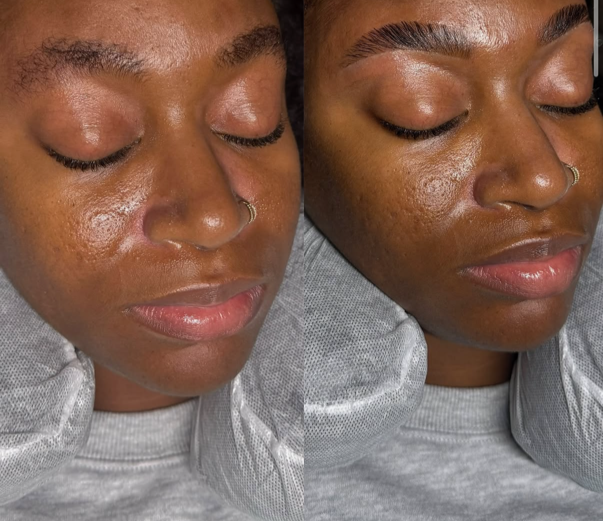 Close-up of a woman with dark skin and a nose ring, showing before and after images of her skin with improved texture and reduced pores.