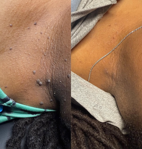 Close-up of a person's armpit with multiple large, raised, wart-like skin growths on the left side, and a clear, smooth armpit with minimal hair on the right side.