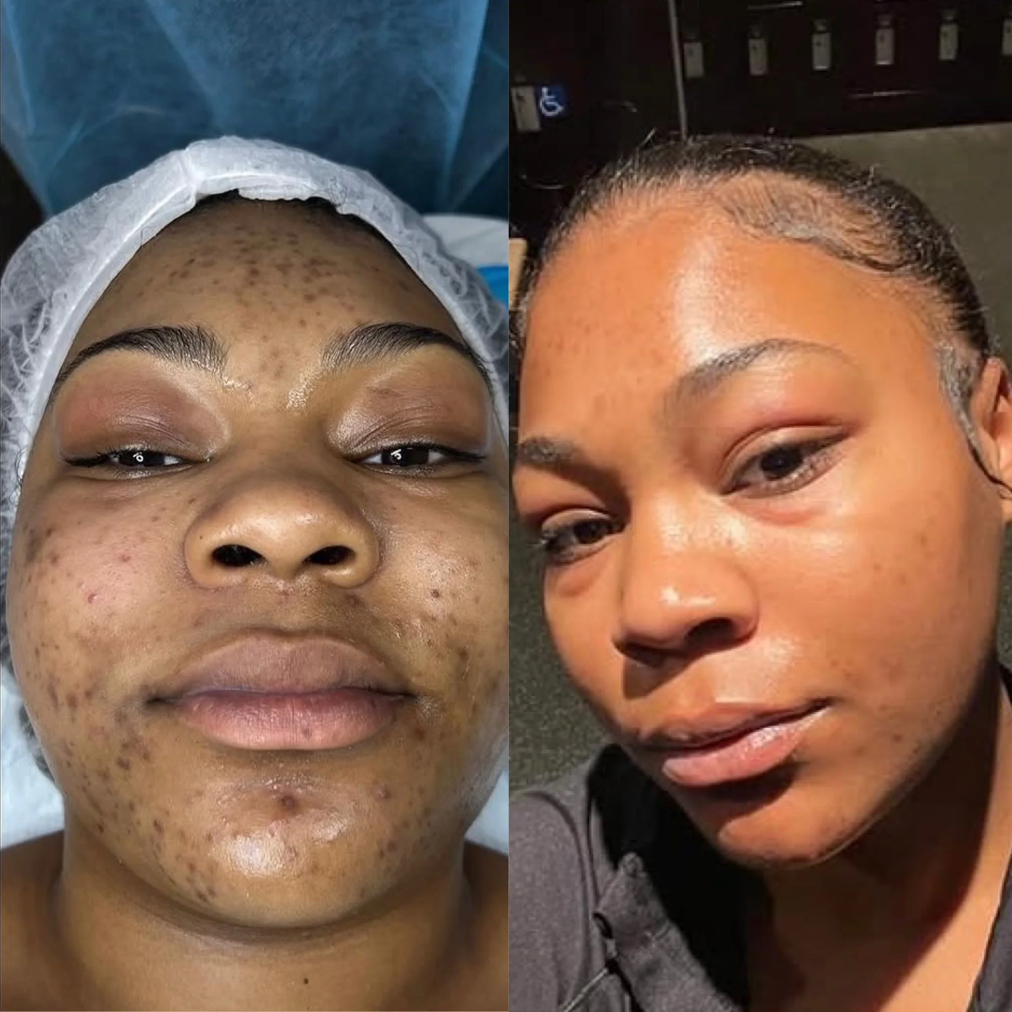 Side-by-side comparison of a woman's face before and after skincare or cosmetic treatment, showing improved skin texture and appearance.