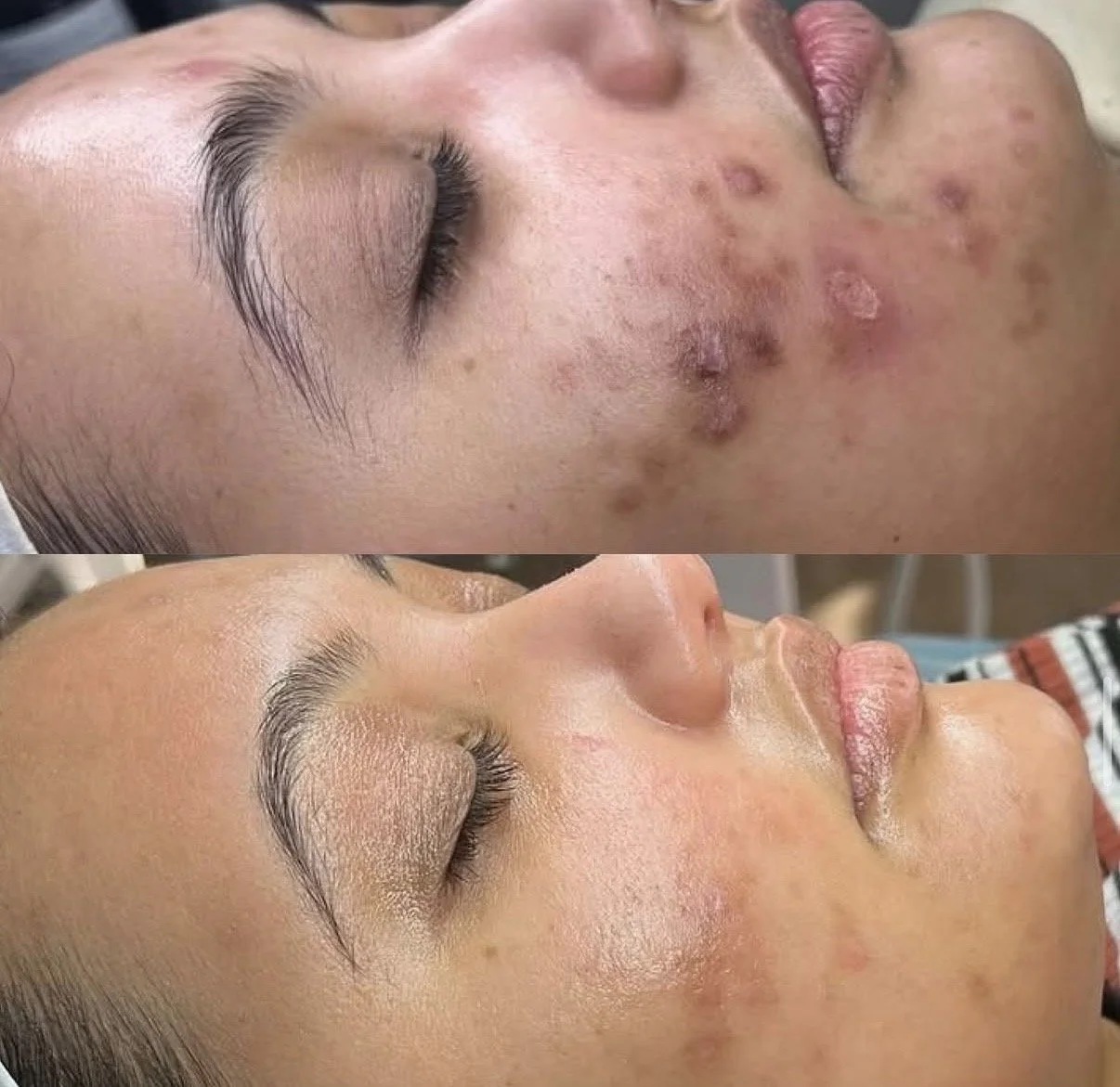 Before and after images of a person’s face showing the improvement in skin condition following a skincare treatment, with noticeable reduction in acne and skin clarity enhancement.