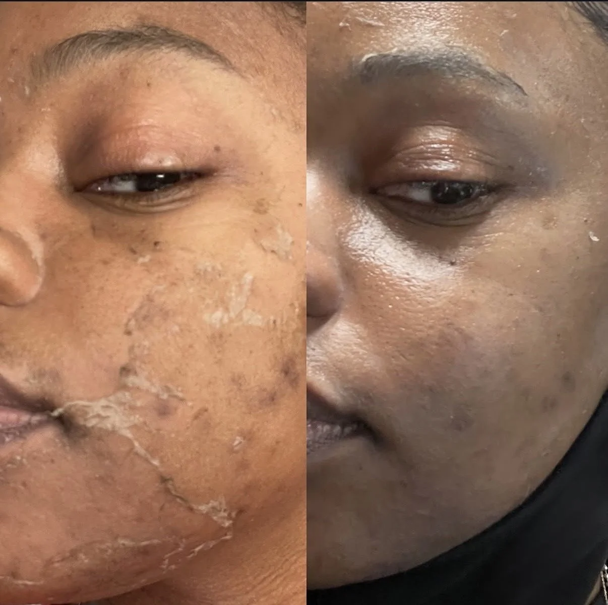 Close-up comparison of a person's face showing skin improvement, with visible dry, peeling skin on the left and clearer, smoother skin on the right.