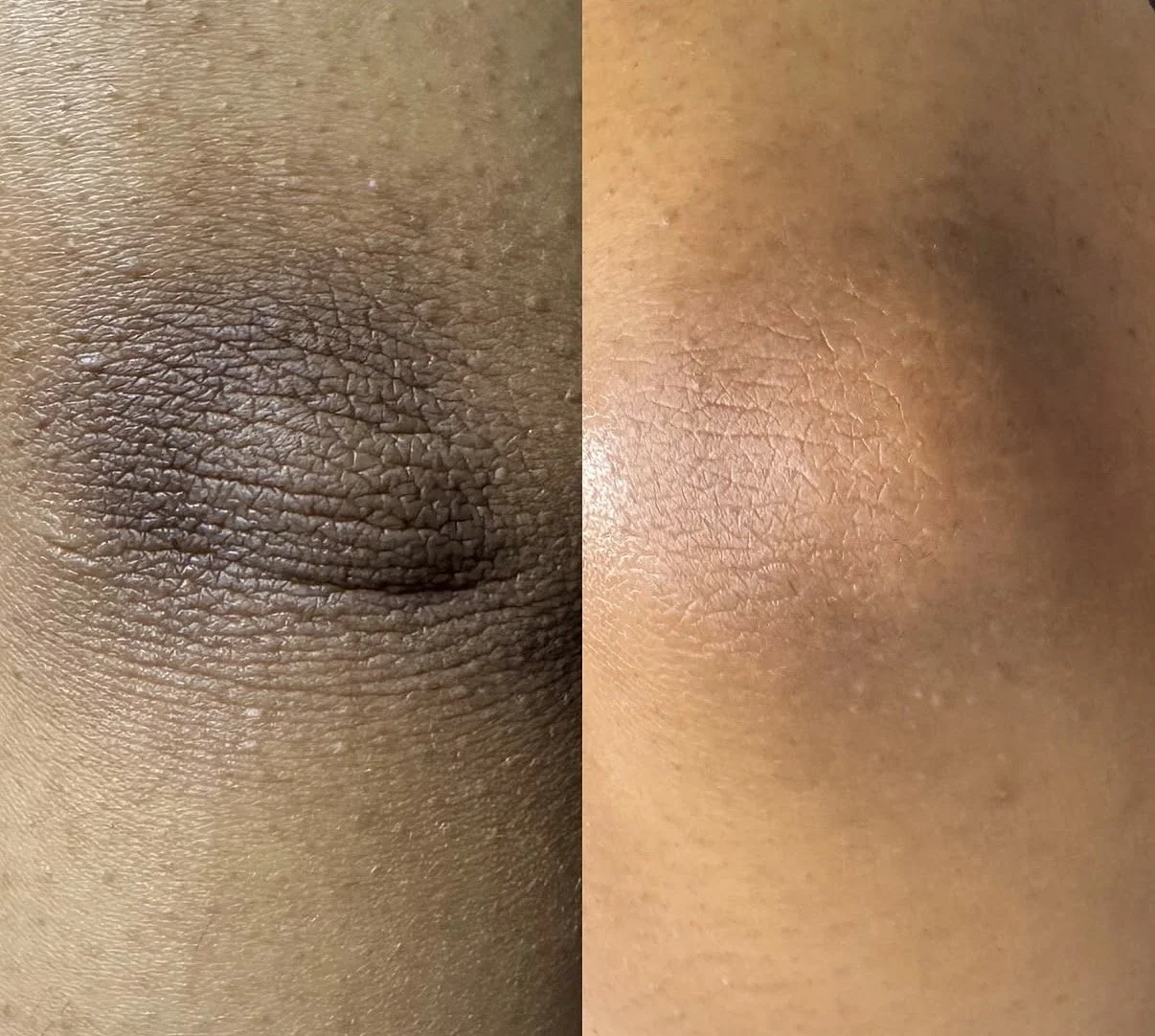 Close-up comparison of dark and light skin tones, highlighting differences in skin texture and pigmentation.