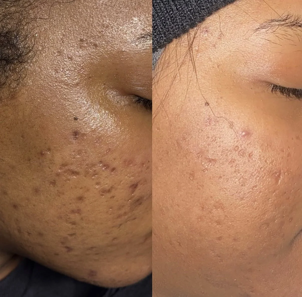 Side-by-side comparison of a person's cheek before and after skincare treatment, showing reduction in acne and skin texture improvement.