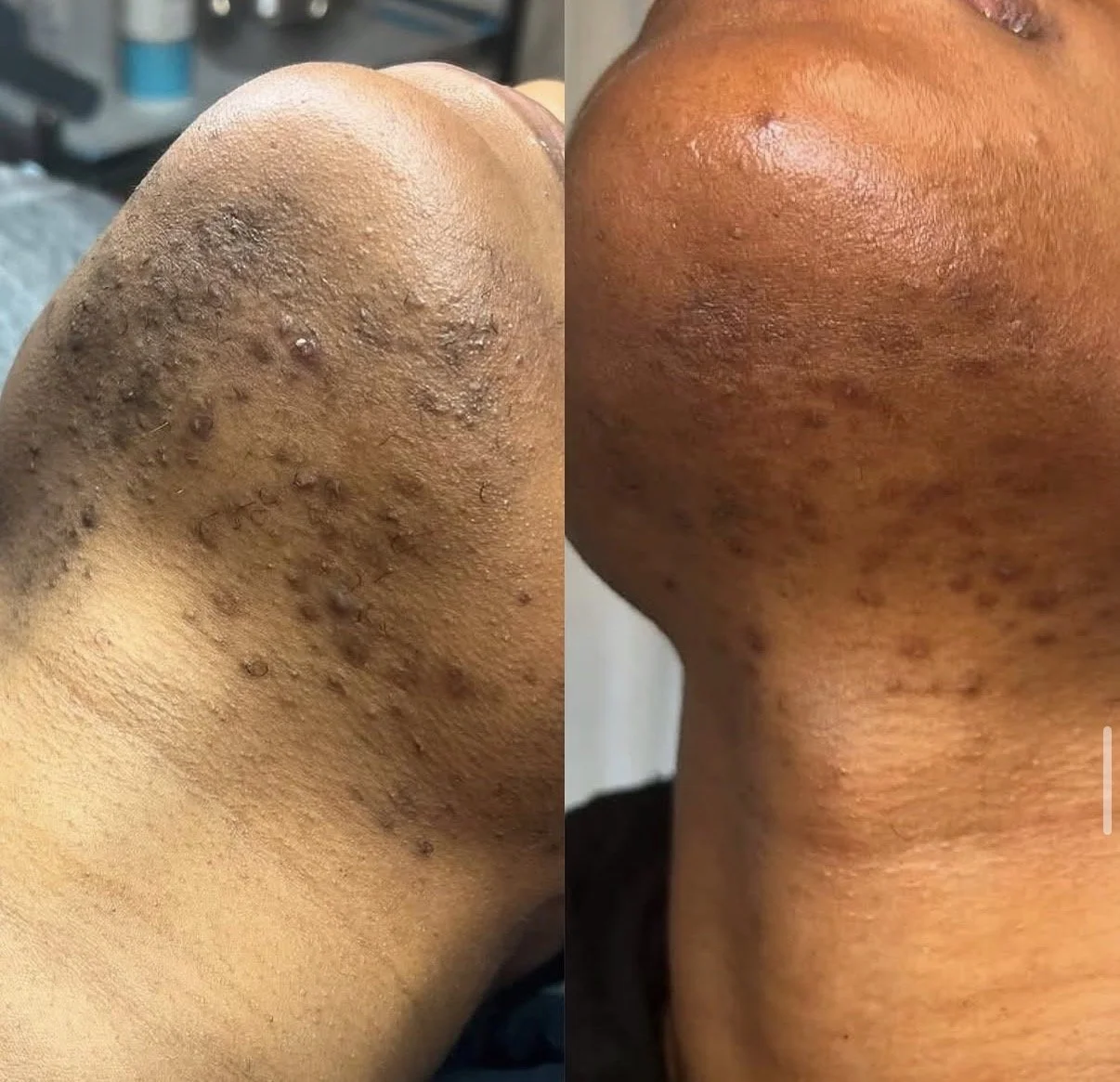 Side-by-side comparison of a person's heel with severe skin condition, showing bumps and discoloration on the left, and the same heel after treatment with clearer skin and fewer bumps on the right.