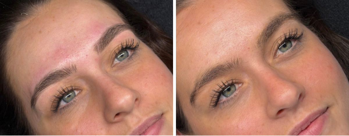 Side-by-side comparison of a woman's face, showing before and after skincare or cosmetic treatment, highlighting improved skin clarity and texture.