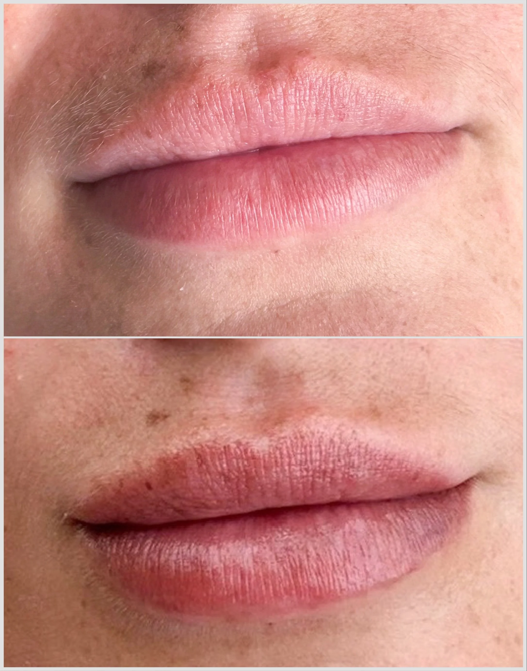Close-up comparison of lips showing a small dark spot on the upper lip before and after treatment
