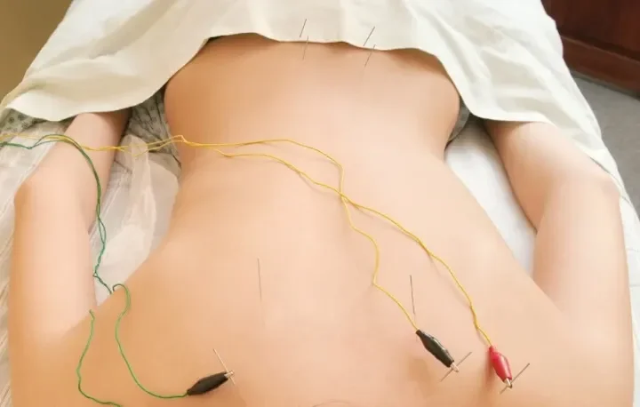Close-up of a person's back with acupuncture needles and electrical wires attached for electroacupuncture treatment.