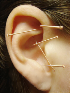 Close-up of a human ear with multiple acupuncture needles inserted at various points.