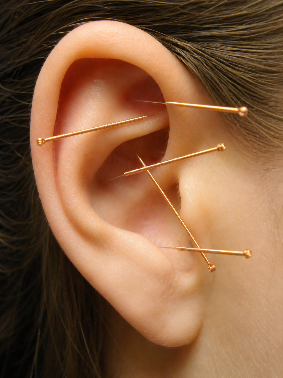 Close-up of a human ear with multiple acupuncture or pin-massage needles inserted.