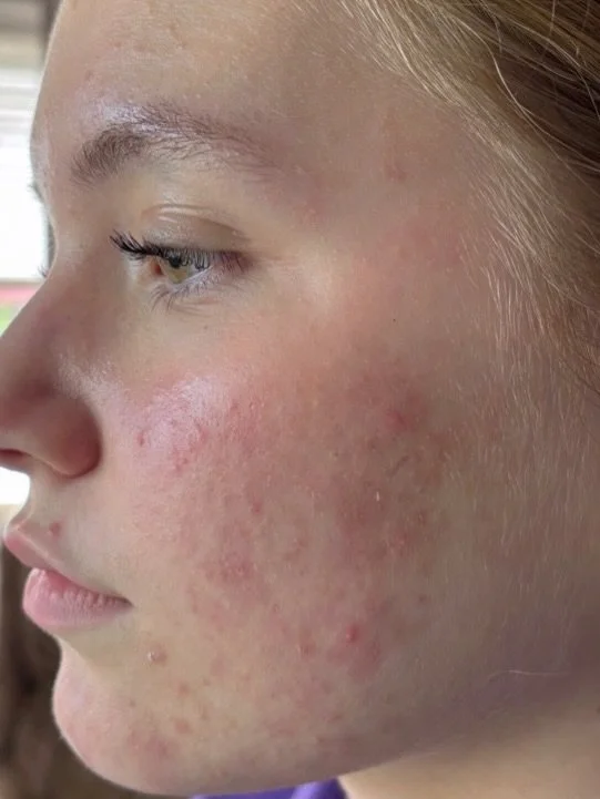 VIRTUAL CLIENT UPDATE 1 MONTH (swipe to see the before)

When I asked if I could take a picture of her face and she stood in the natural light, I said &ldquo;holy shit olivia!&rdquo; In amazement. She flushed so bad we had to wait till she was back t