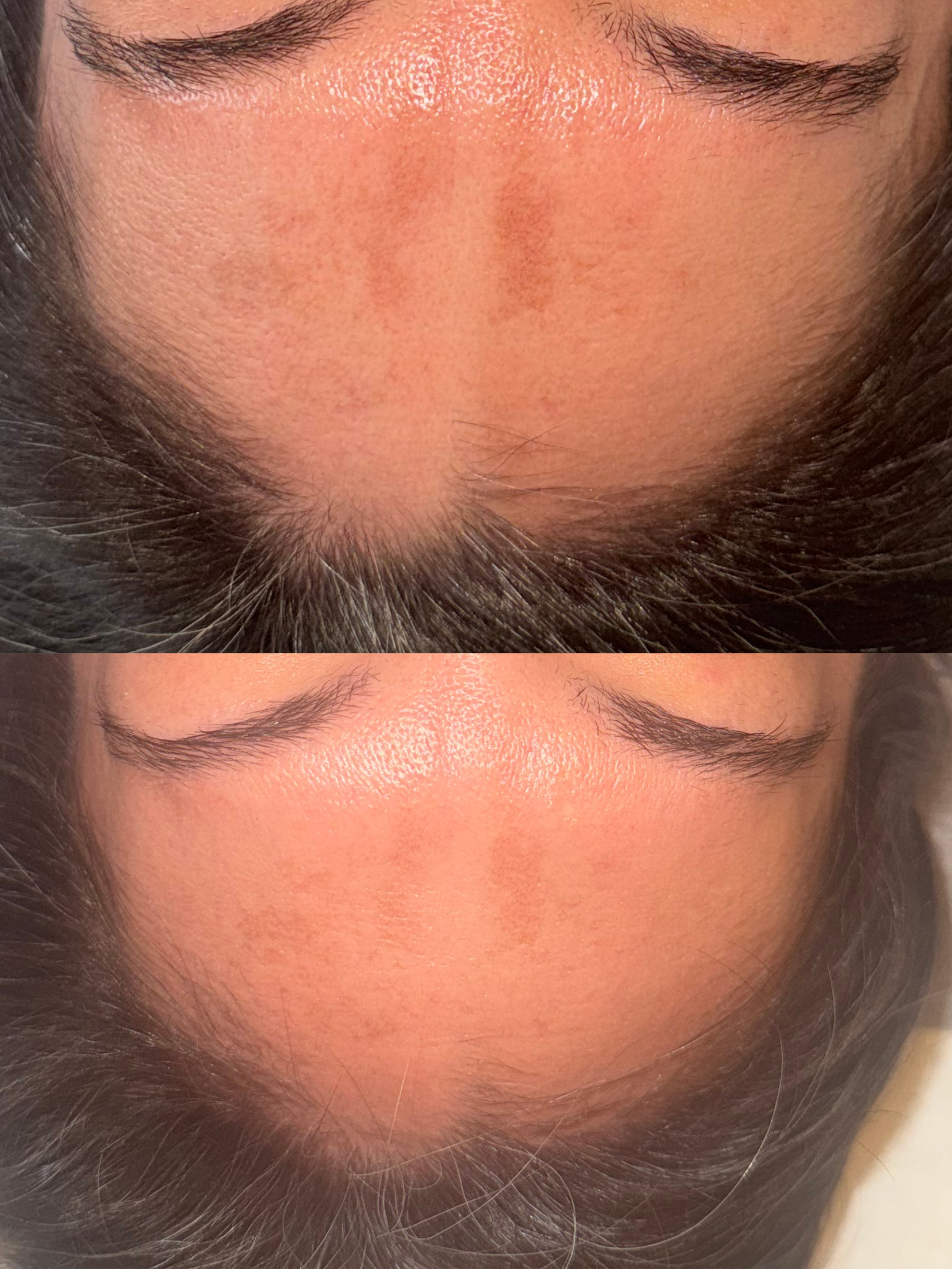 Microneedling with Invo