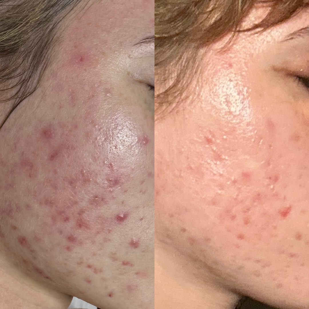 Microneedling for active Acne