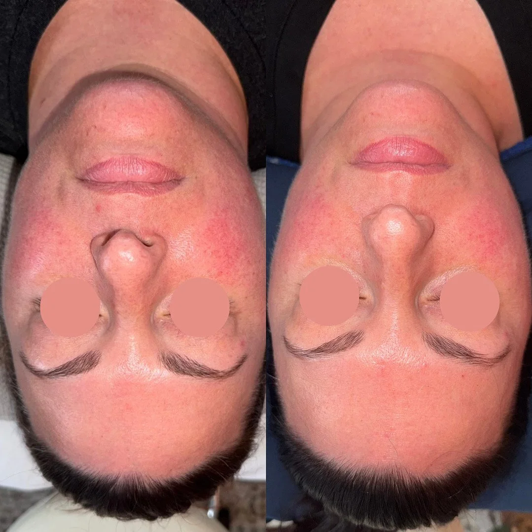 Microneedling for Rosacea