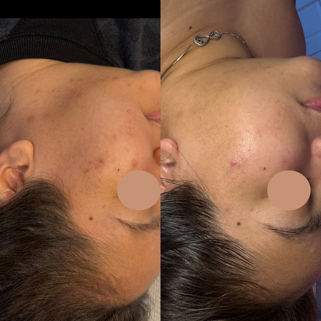 Microneedling for Hyperpigmentation