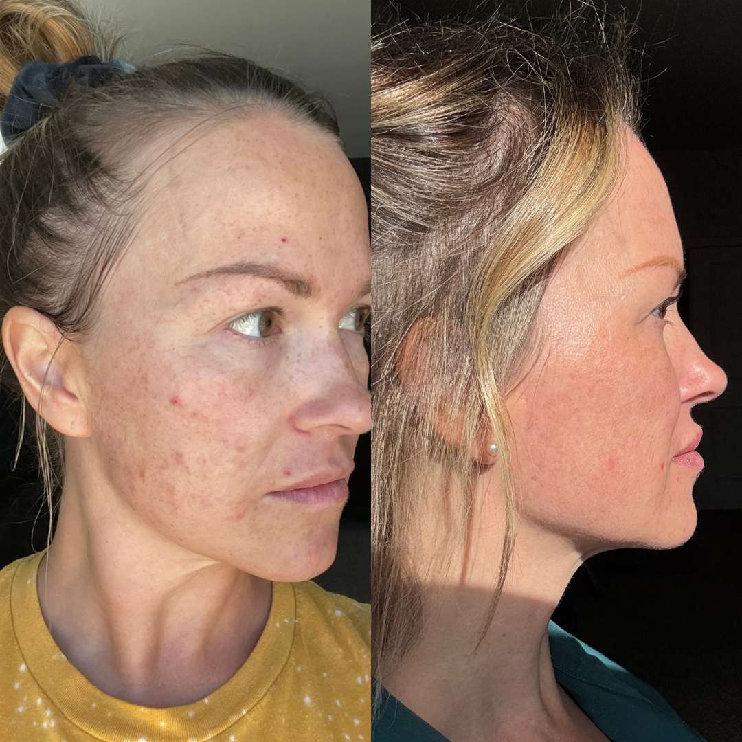 Microneedling + Correct Products