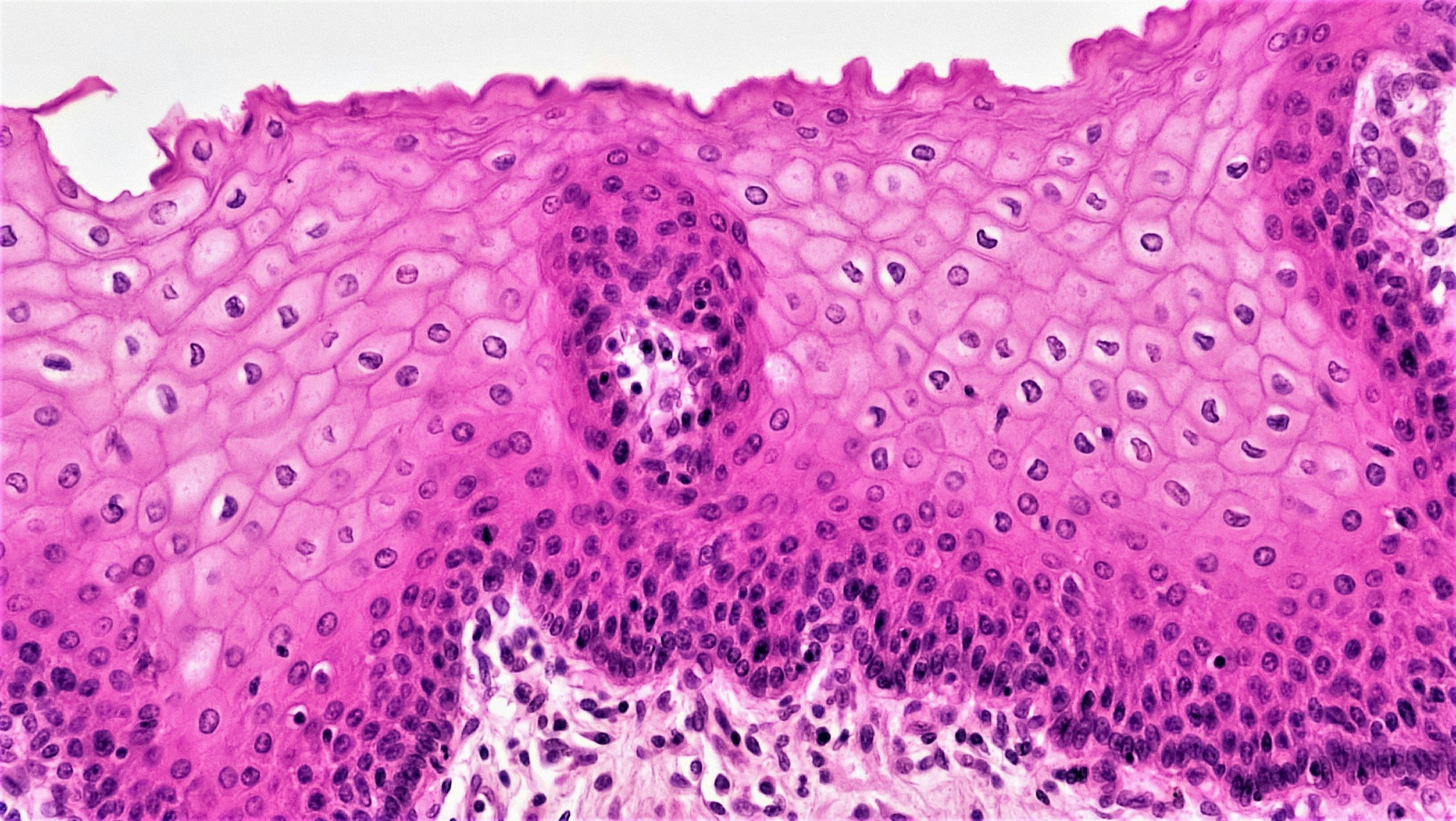 Was your endometriosis biopsy histologically tested for PGP9.5 &amp; Ki67 ?