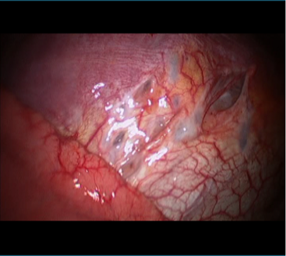 A Patient-Advocate's Guide to Recognizing Thoracic endometriosis