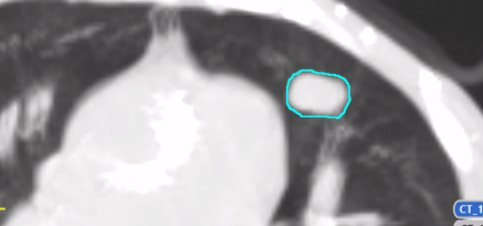 A Maximum Intensity Projection showing the full extent of lung tumor motion.