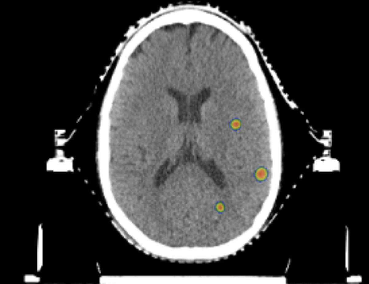 A medical brain scan image, likely an MRI or CT scan, showing a grayscale cross-sectional view of the brain with highlighted spots indicating areas of interest or concern.