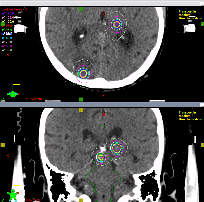 Medical imaging scans showing cross-sectional and frontal views of a skull with highlighted regions indicating radiation dose levels, used for radiosurgery treatment planning.