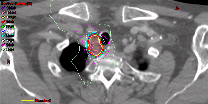 Cross-sectional CT scan showing isodose levels in radiation therapy treatment planning, with color-coded contours indicating different radiation doses.