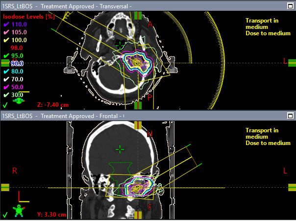 A radiosurgery treatment plan with color-coded dose levels and targeted treatment area outlined.