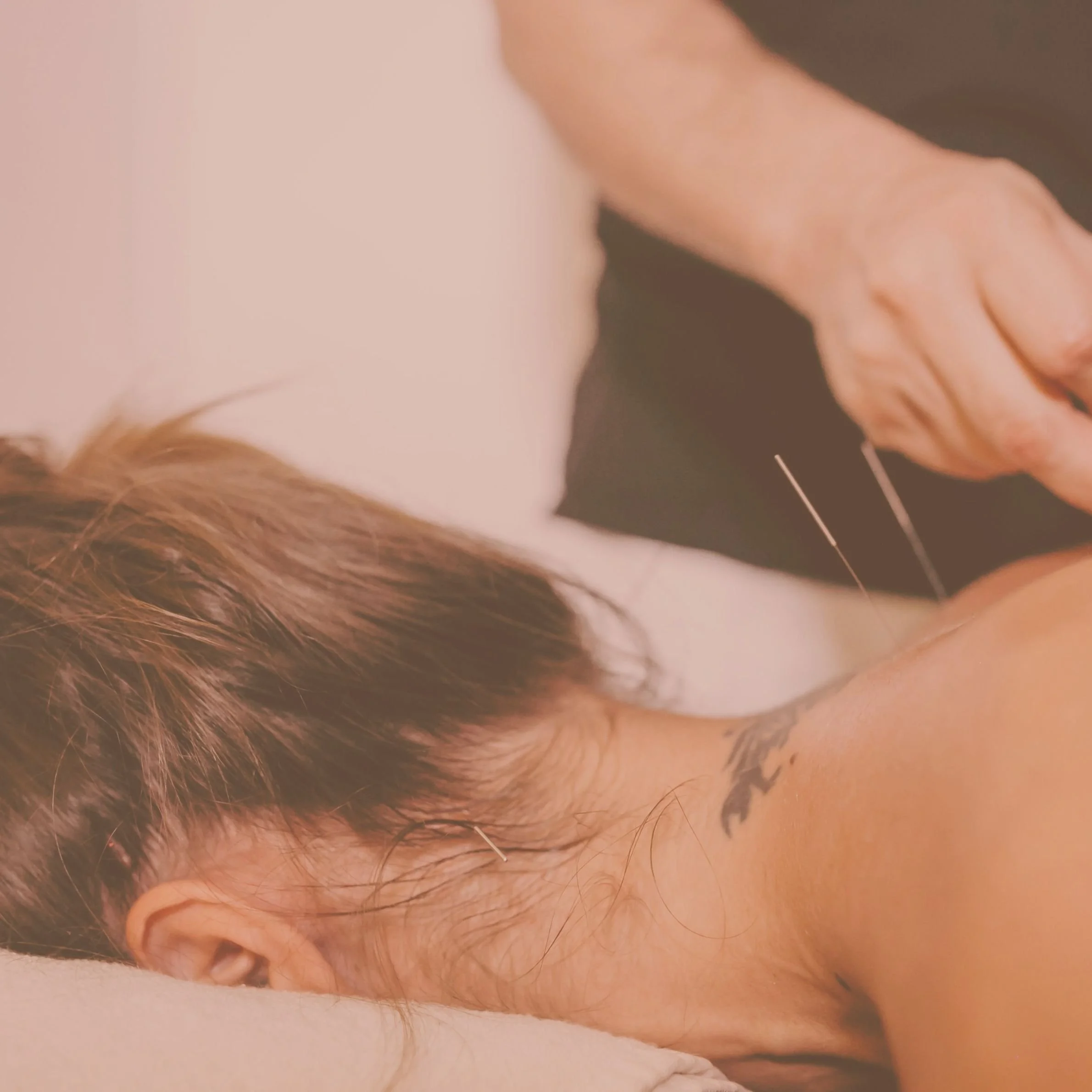 Dry Needling