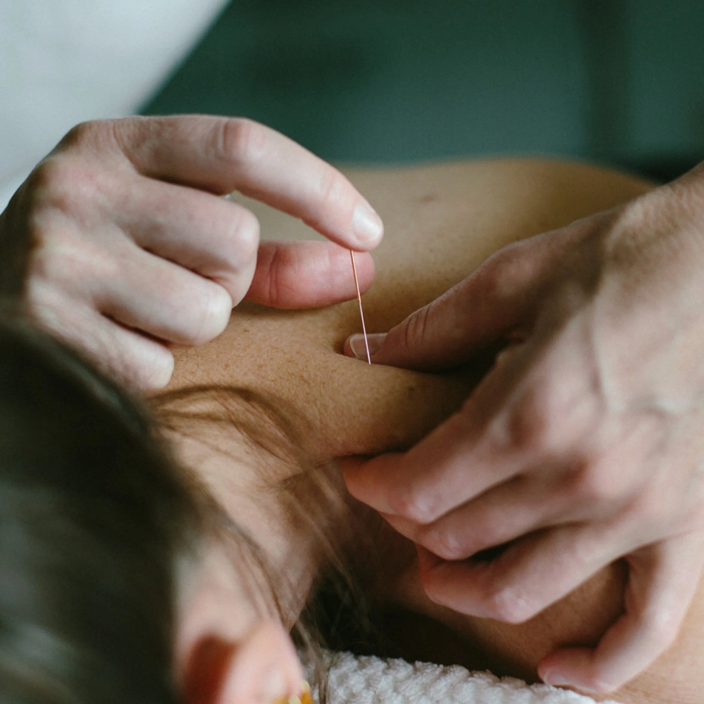 Dry Needling