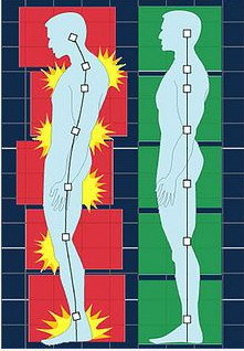 Diagram of a human figure showing nerve pain or energy points on the left side with yellow warning signs, and a normal figure on the right side without signs or indications.