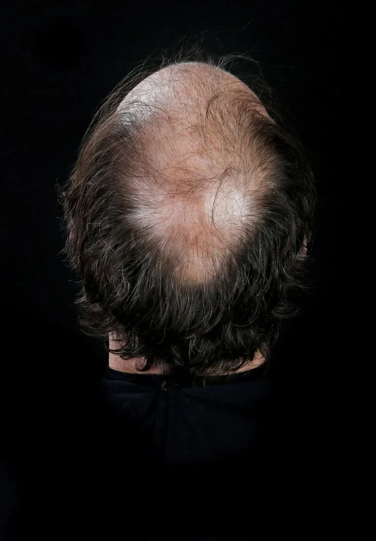 Top view of a man with thinning hair on the crown, showing baldness and scalp with some longer dark hair around the sides.