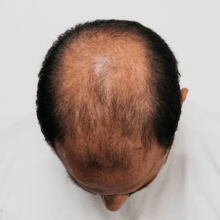 HAIR LOSS