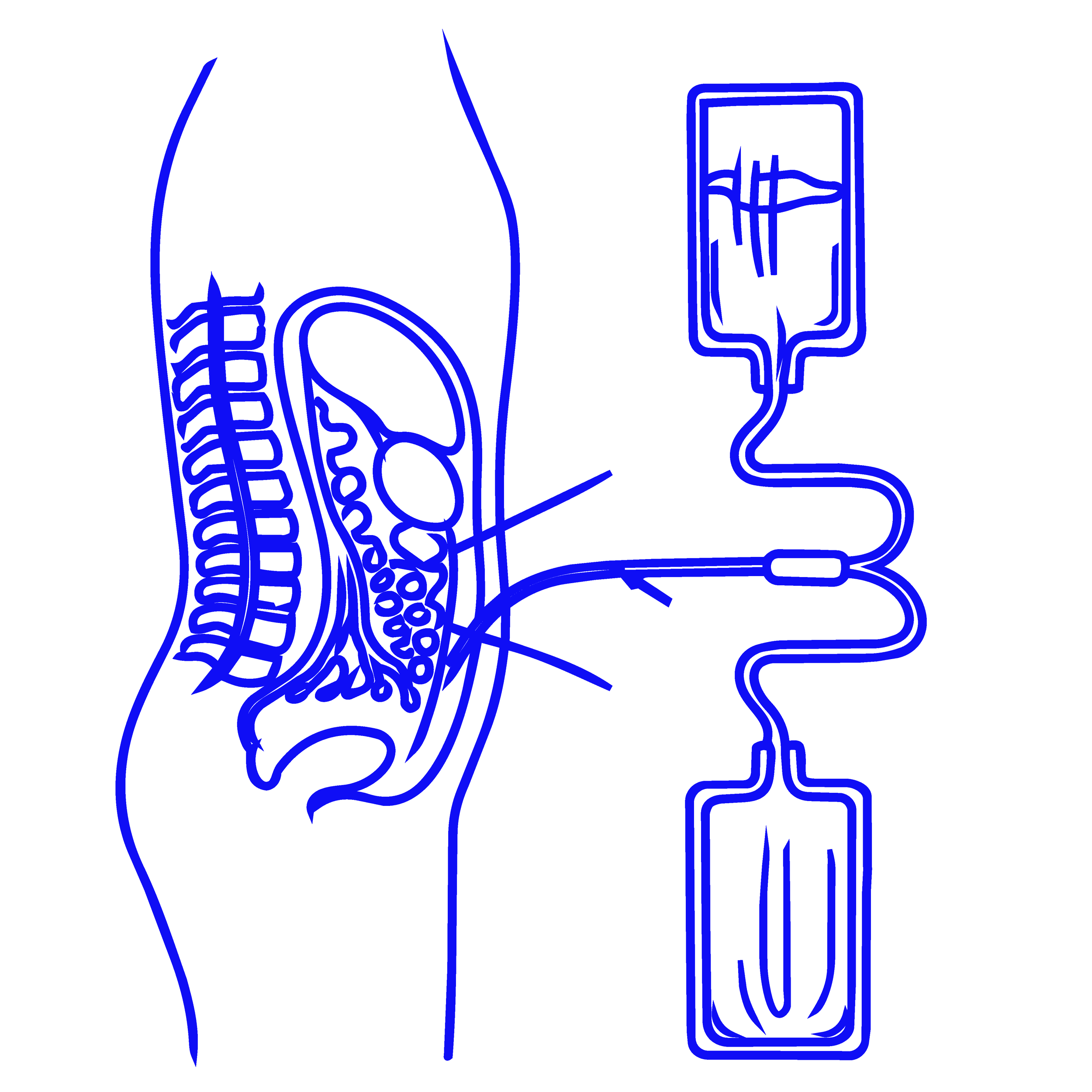 Outline drawing of a human torso with the skeletal system and internal organs, connected to a medical IV bag.