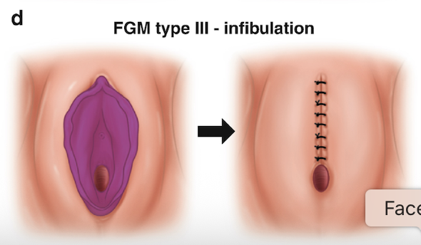Diagram showing FGM type III infibulation with initial genital area on the left and post-surgical suturing on the right.