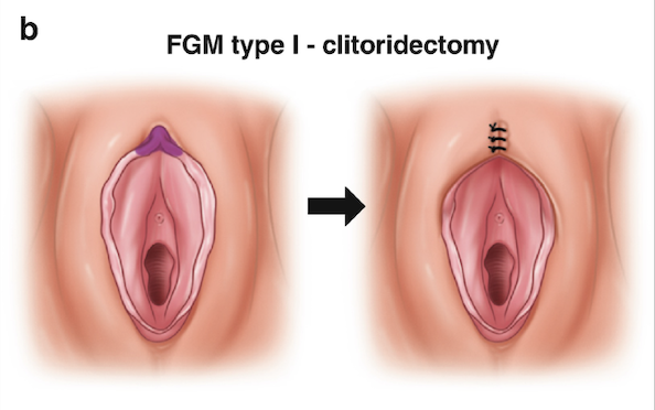 Diagram showing a medical procedure called FGM type 1 clitoridectomy, with before and after illustrations of the female genitalia, including an arrow indicating the surgical change and sutures on the after image.