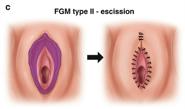 Diagram showing FGM type II excision, illustrating the removal of part of the female genitalia with sutures to close the wound.