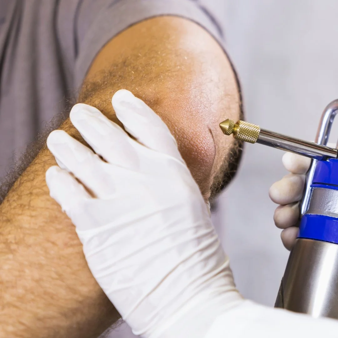 Doctor performing cryotherapy dry ice treatment for solar keratosis