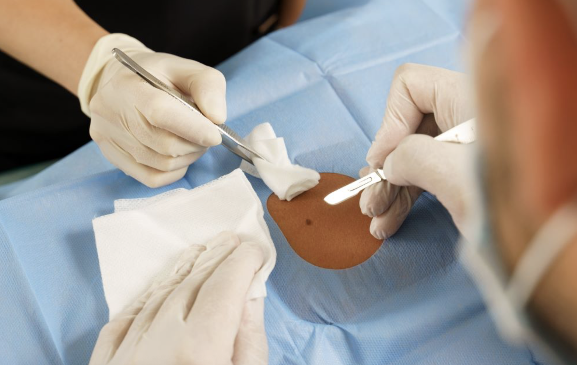 Clinician performing shave biopsy. Sterile setting. Professional clinic