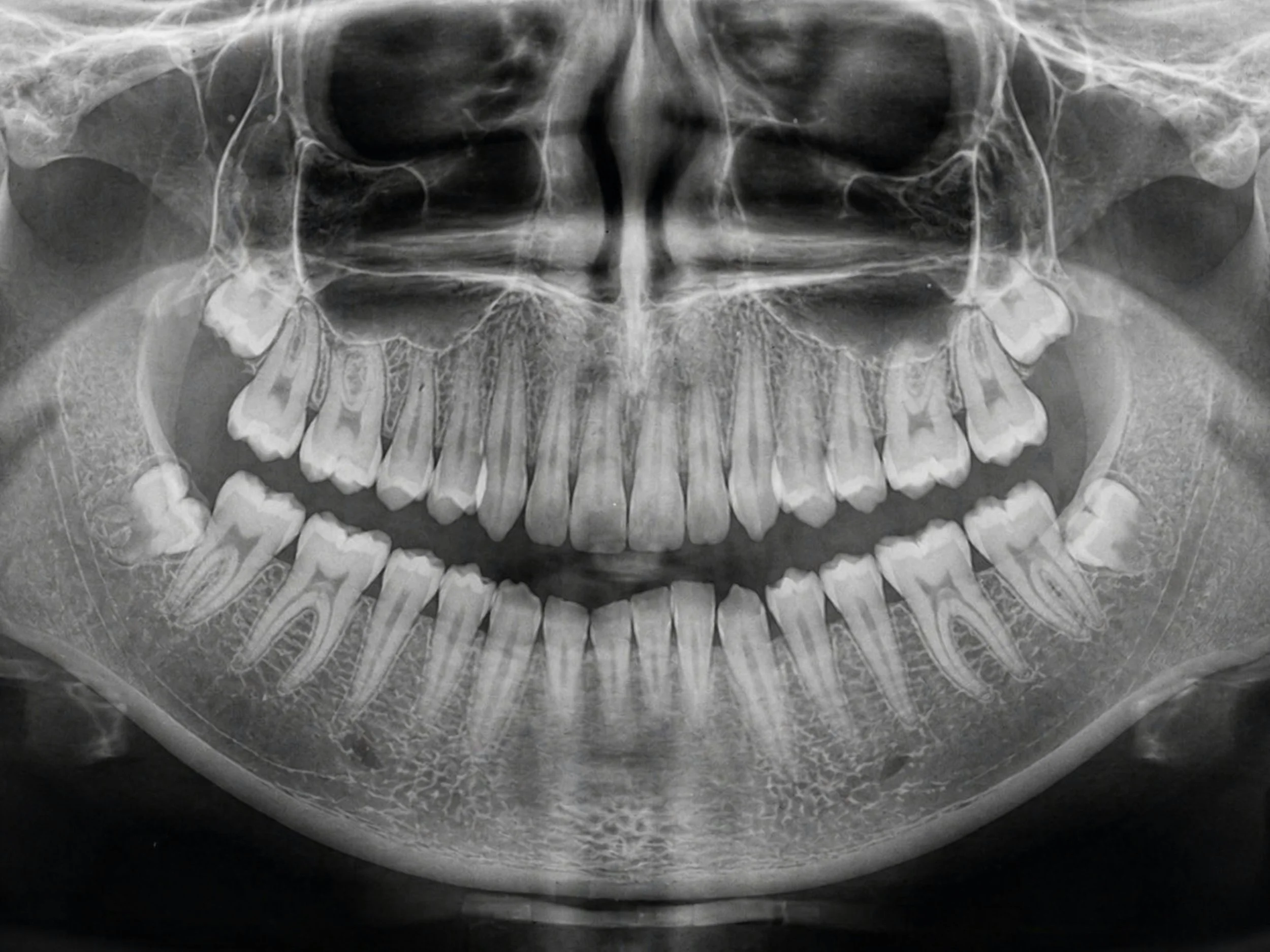 Wisdom teeth removal with patients being put to sleep with IV Sedation.