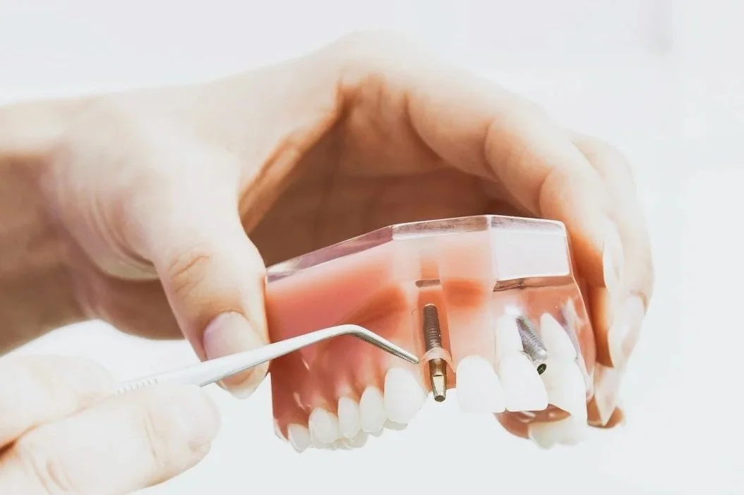 Dental implant for a single tooth or multiple teeth using titanium hardware to replace a missing tooth.