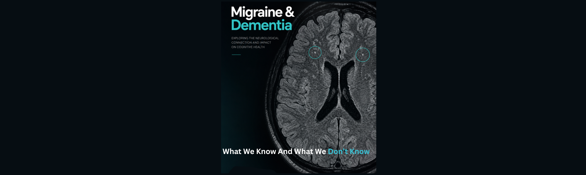 Does Migraine Increase Dementia Risk? The Science Is More Complicated Than You Think
