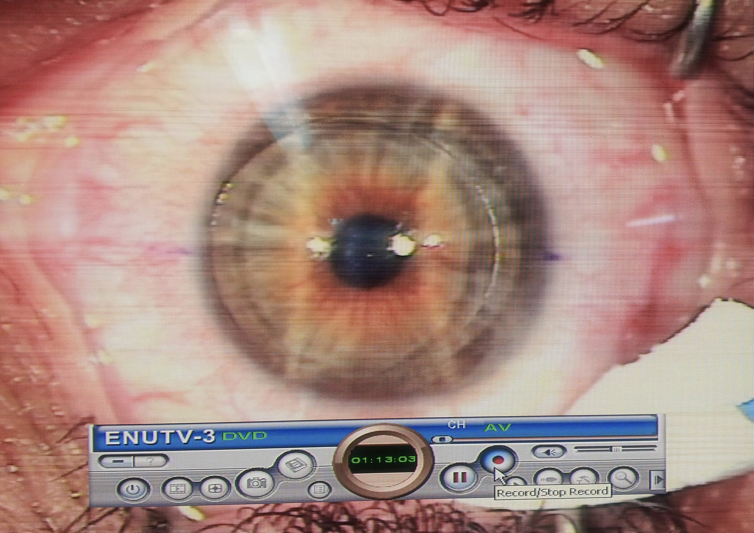 Cirugía Refractiva