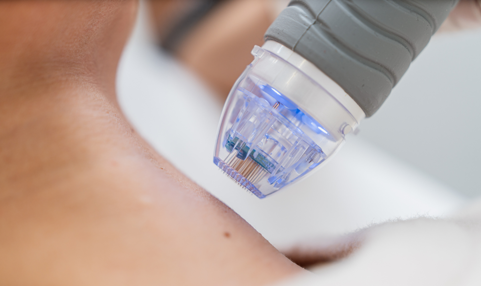 Medspa in Menifee, CA, 92584 RF Microneedling Near Me.png