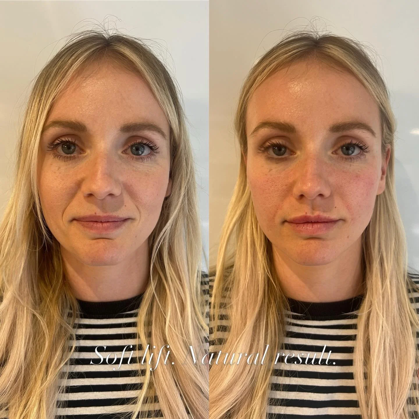 💫 Small amounts
💫 Using the right product (Teoxane 💙)
💫 Placed in the right anatomical places

= Lifted, naturally 🌿

Cheeks, nasolabial folds &amp; lips