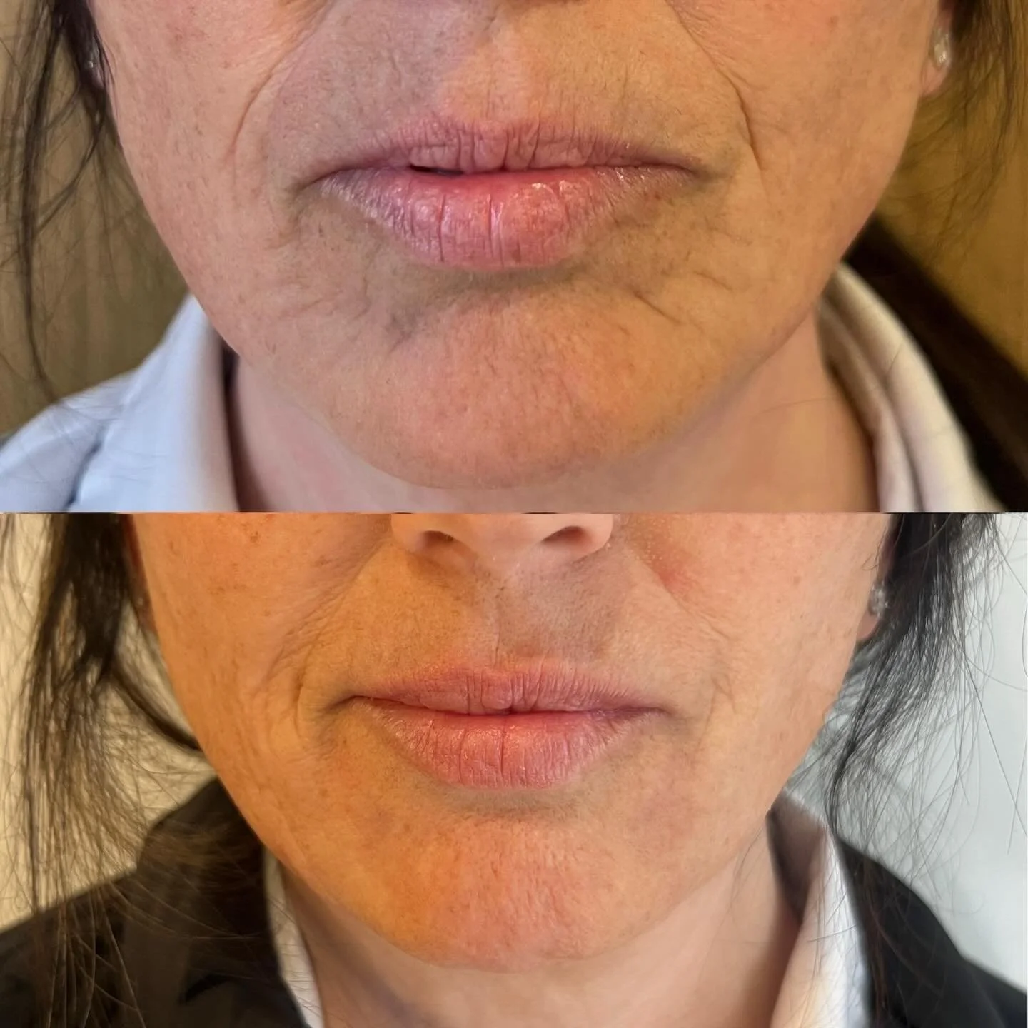 &ldquo;I don&rsquo;t want to look like I&rsquo;ve had something done&hellip; I just want to look refreshed.&rdquo; 💫

Subtle lip enhancement and softening of the fine lines around the mouth.

💫 Restoring shape
💫 Smoothing perioral lines
💫 Keeping