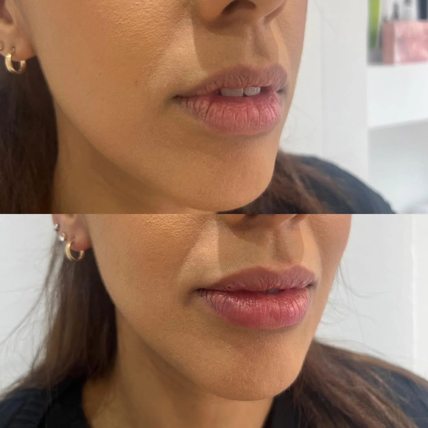 💫 Subtle lip augmentation
💫 Enhancing natural lip shape
💫 Always keeping results natural

Results tailored to each lip shape.