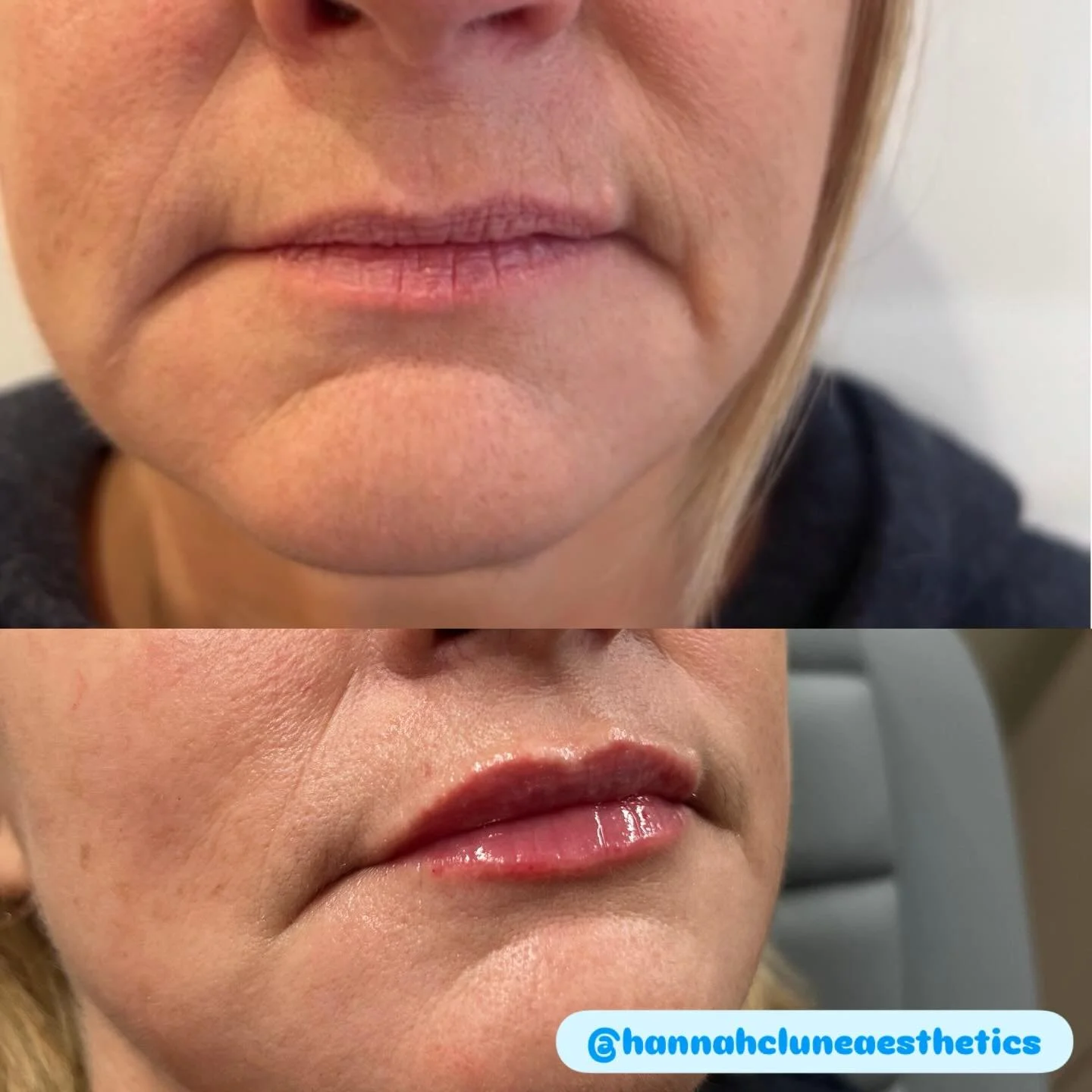 ☑️Rejuvenated
☑️Hydrated
☑️Natural 
☑️Mistletoe ready 💋🎄

@hannahcluneaesthetics #lipfiller #aestheticsbarnstaple #barnstaple