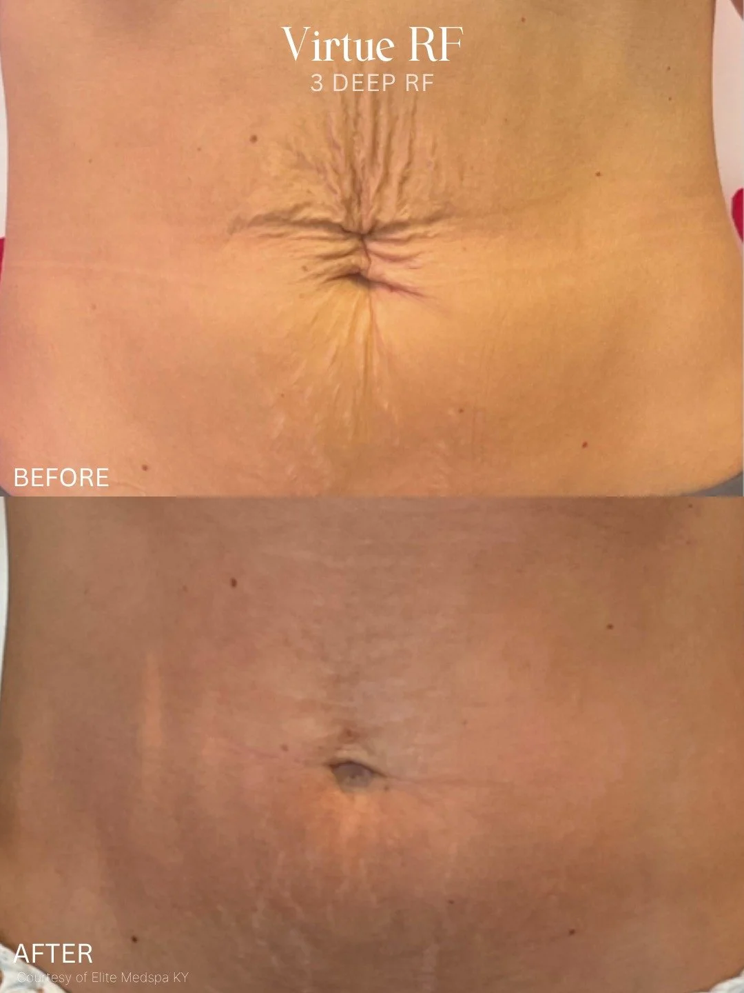 This is what collagen remodeling can look like 👏👏👏

This before + after shows the abdomen following a series of 3 VirtueRF Deep treatments!

By combining microneedling with radiofrequency energy, VirtueRF works beneath the skin to stimulate collag