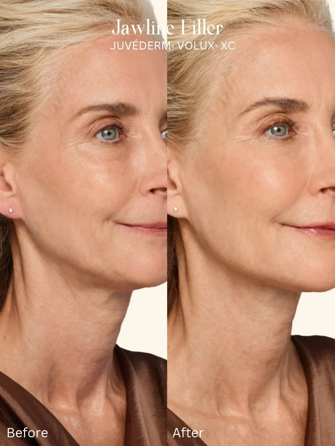 Looking for a little more definition through the jawline?

Jawline filler can help create a sharper, more structured lower face by adding support exactly where it&rsquo;s needed. With thoughtful placement, it can define the angle of the jaw, improve 