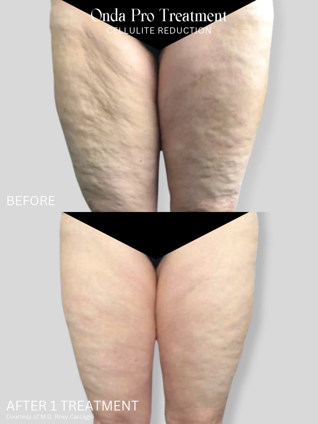 One treatment. A noticeable difference. 👏

Onda PRO uses targeted energy to address the appearance of cellulite and improve skin texture, helping create a smoother, more even look. And yes, these results are after just **one treatment**.

Ready to s